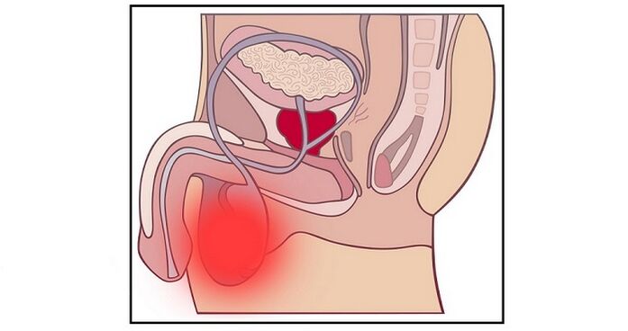 Eine Komplikation einer Penisvergrößerungsoperation kann eine Hodenentzündung sein. 