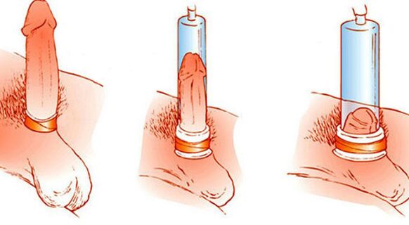 Das Funktionsprinzip einer Vakuumpumpe, die den Penis vergrößern kann