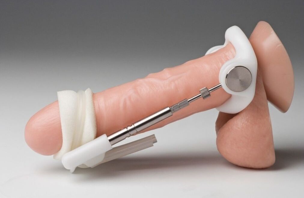 Erweiterung, um die Dicke des Penis zu erhöhen